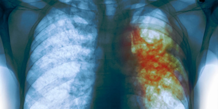 Disminución de incidencia de Tuberculosis en Paraguay Disminución de incidencia de Tuberculosis en Paraguay