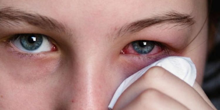 Adecuada higiene de manos permite evitar contagio de conjuntivitis