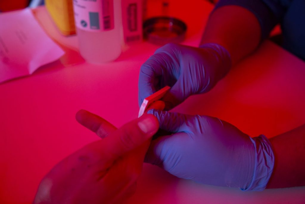 Segundo caso mundial de remisión del virus del sida en un paciente Segundo caso mundial de remisión del virus del sida en un paciente