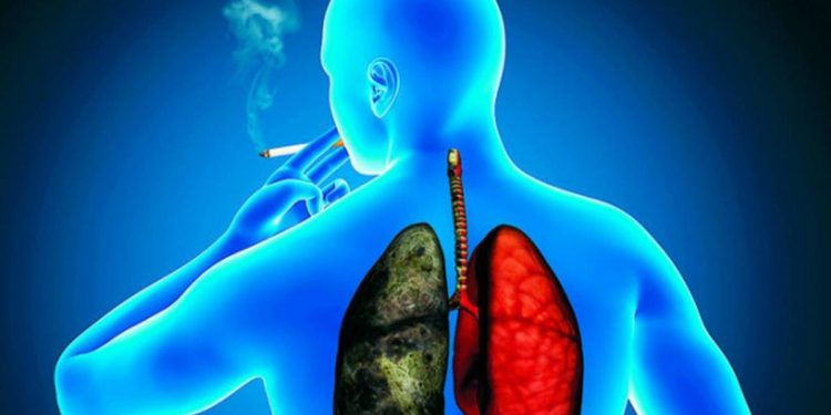 Paraguay: en código rojo por cáncer de pulmón