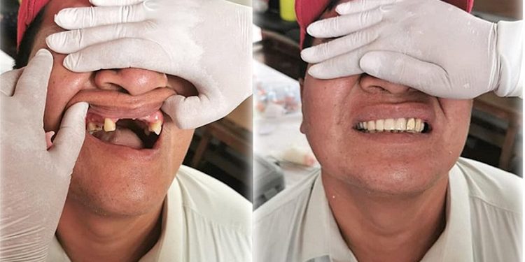Chaqueños reciben prótesis y lucen nuevas sonrisas Chaqueños reciben prótesis y lucen nuevas sonrisas