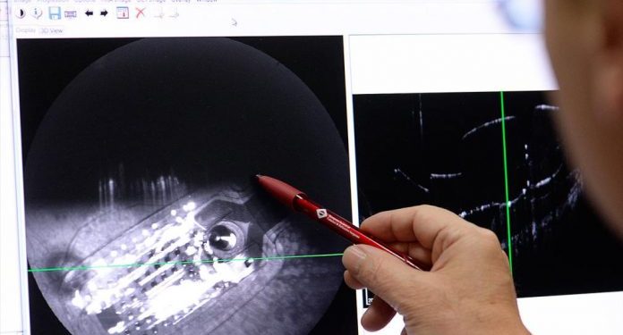 Mujer británica recupera su visión tras recibir primer implante de un chip biónico Mujer británica recupera su visión tras recibir primer implante de un chip biónico