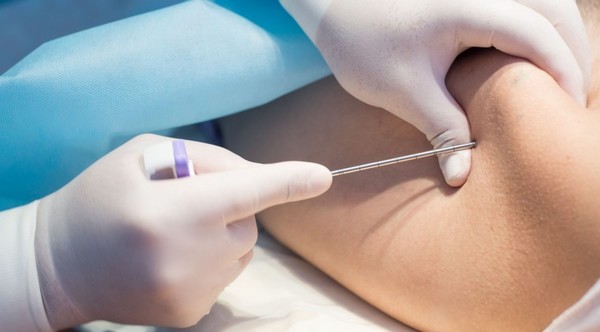 Para ser beneficiado con trasplante de médula ósea se aplican criterios médicos Para ser beneficiado con trasplante de médula ósea se aplican criterios médicos