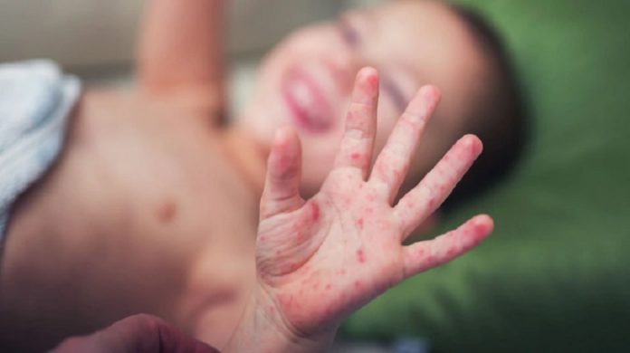 Continúa campaña de vacunación contra sarampión, rubéola, y polio