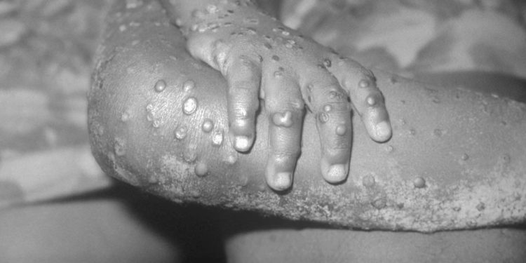 Viruela del mono: enfermedad es leve y se estudia aparición fuera de zonas endémicas