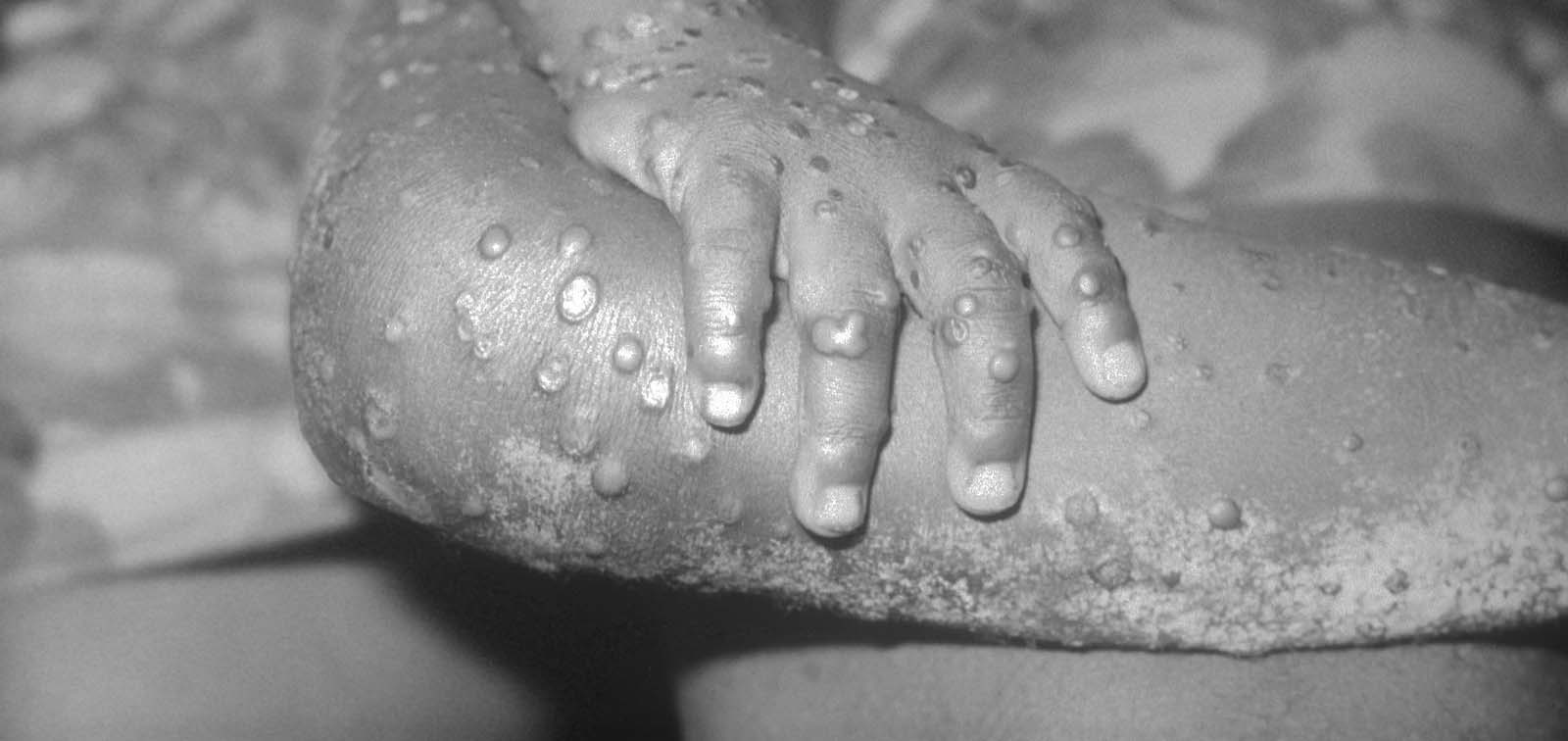 Viruela del mono: enfermedad es leve y se estudia aparición fuera de zonas endémicas