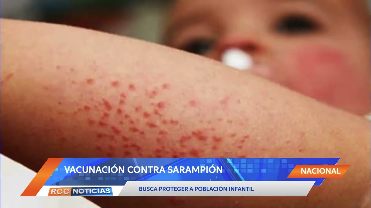 Vacunación contra sarampión busca proteger a población infantil ante riesgo de reintroducción.