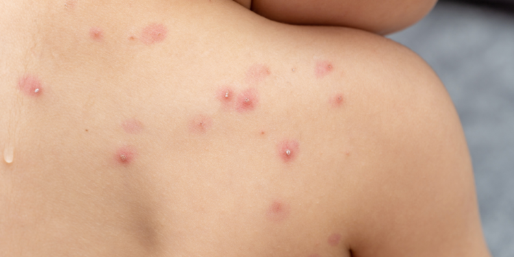 Confirman primer caso de viruela símica e instan a consultar ante sospechas de la enfermedad