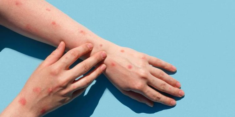 Ya son cinco los casos confirmados de la Viruela Símica en Paraguay Ya son cinco los casos confirmados de la Viruela Símica en Paraguay