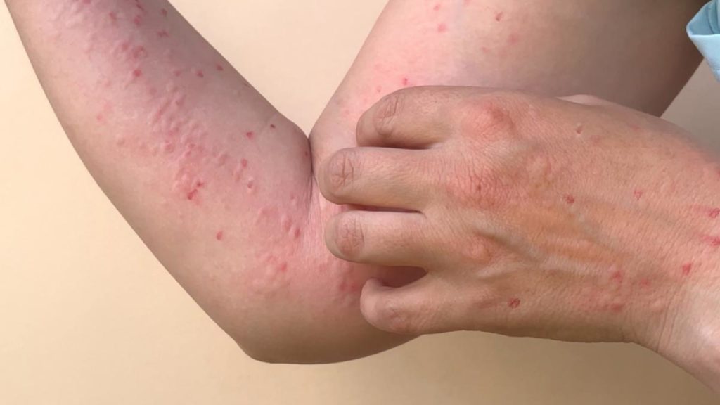 Ya son siete los casos confirmados de viruela del mono en Paraguay, todos del sexo masculino