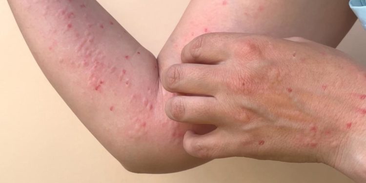 Ya son siete los casos confirmados de viruela del mono en Paraguay, todos del sexo masculino