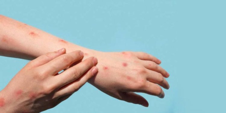 Registran 44 casos de viruela símica en el país