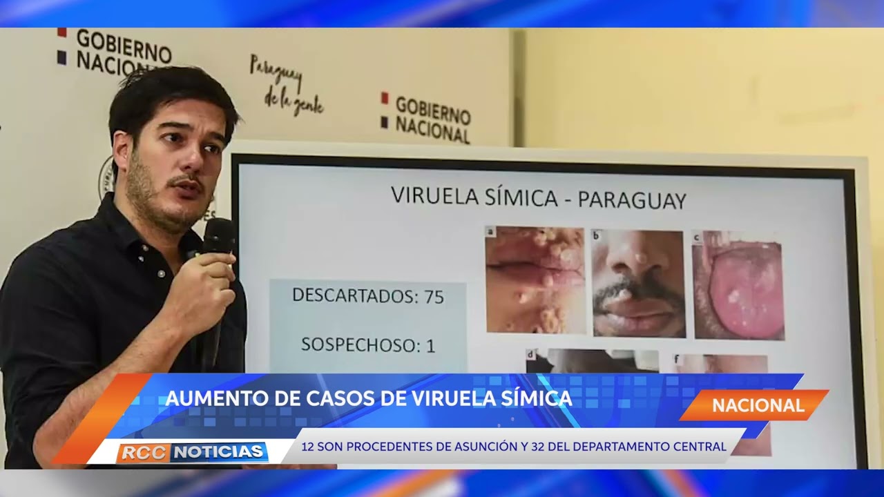 Registran 44 casos de viruela símica en el país