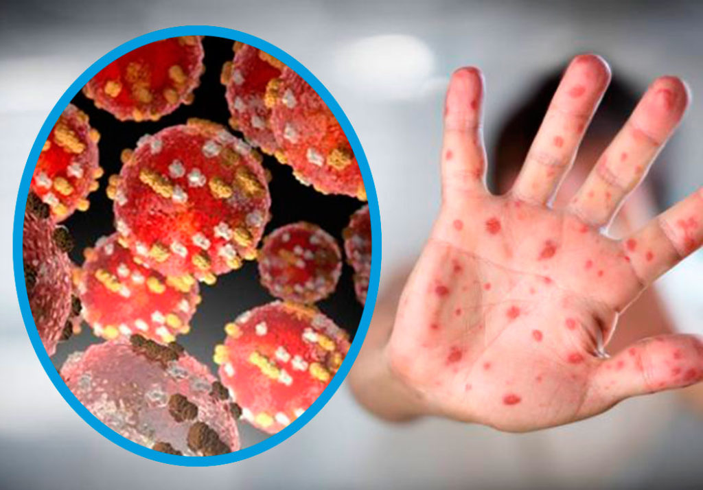 Viruela símica llega a 53 casos confirmados según el reporte de la Dirección General de Vigilancia de la Salud