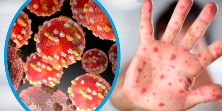 Viruela símica llega a 53 casos confirmados según el reporte de la Dirección General de Vigilancia de la Salud Viruela símica llega a 53 casos confirmados según el reporte de la Dirección General de Vigilancia de la Salud