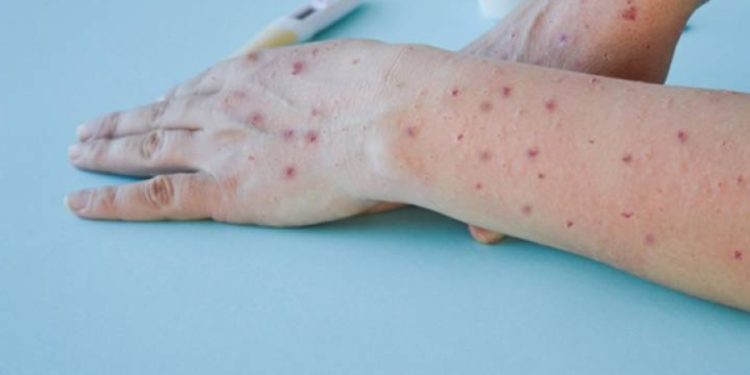 Detectan primer caso de viruela símica en una mujer