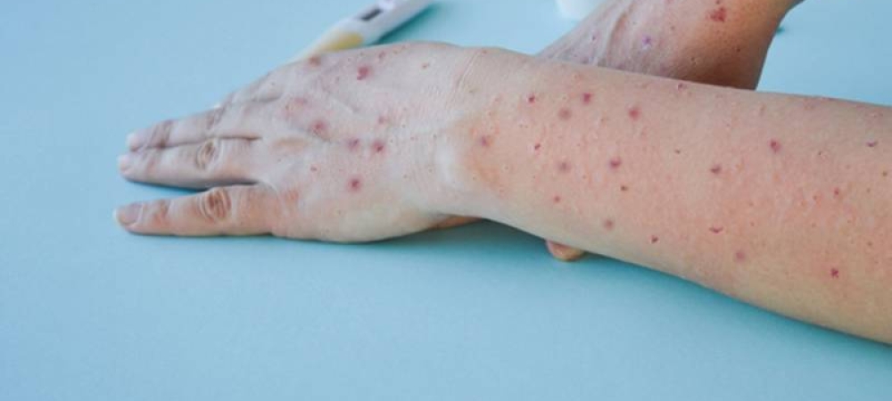 Detectan primer caso de viruela símica en una mujer