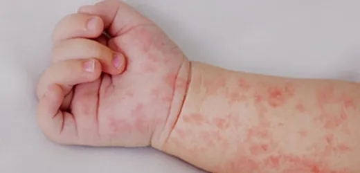 Controlarán tarjeta de vacunación contra el sarampión en instituciones educativas