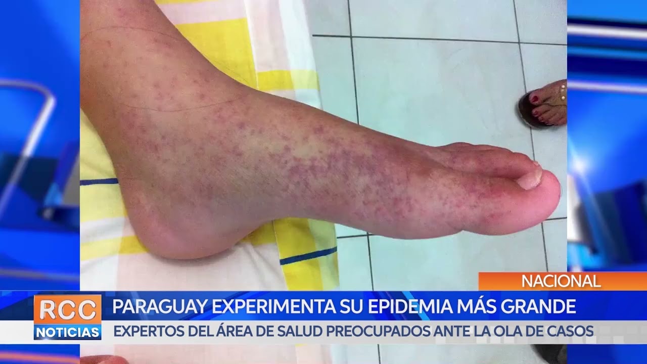 Paraguay experimenta su epidemia más grande de chikungunya, sostienen expertos