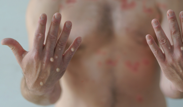 Viruela símica: siguen aumentando los casos y ya llegan a 125 los confirmados
