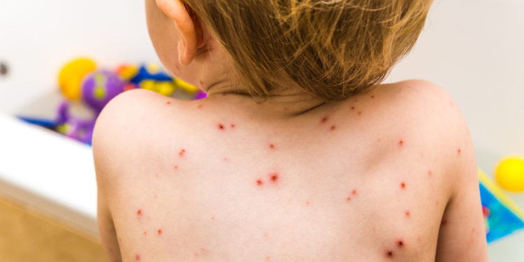 Vigilancia confirma brotes de varicela, habituales en esta época del año Vigilancia confirma brotes de varicela, habituales en esta época del año