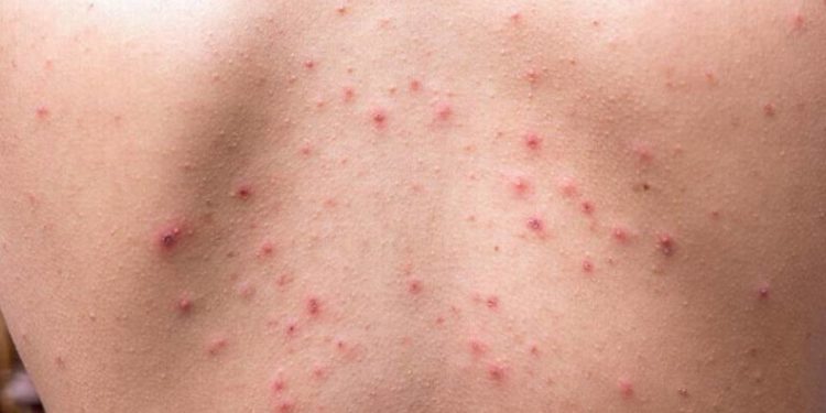 Identifican brote de varicela en colegio militar