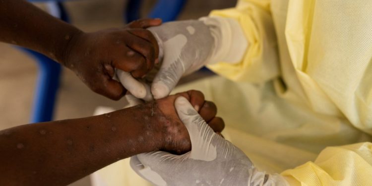 OMS declara emergencia mundial por brote de Viruela del Mono en África