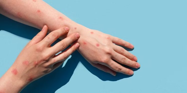 Ministro de Educación descarta caso de viruela del mono en escuela de Luque: «Está absolutamente descartado»