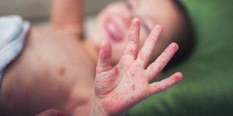 Confirman brote de sarampión en San Pedro y alertan por riesgo de dispersión nacional