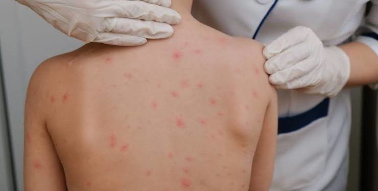 Confirman tres nuevos casos de sarampión y el total asciende a 38 en el país