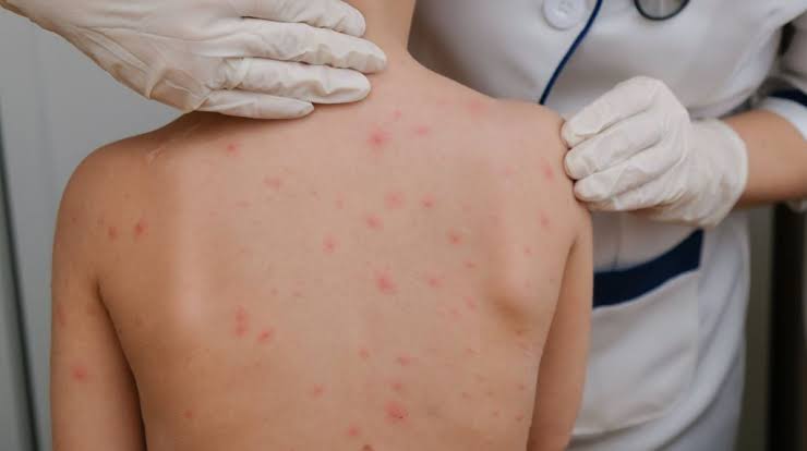 Confirman tres nuevos casos de sarampión y el total asciende a 38 en el país