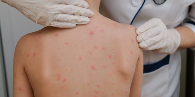 Suman 26 los casos de sarampión en Paraguay y refuerzan vacunación en San Pedro