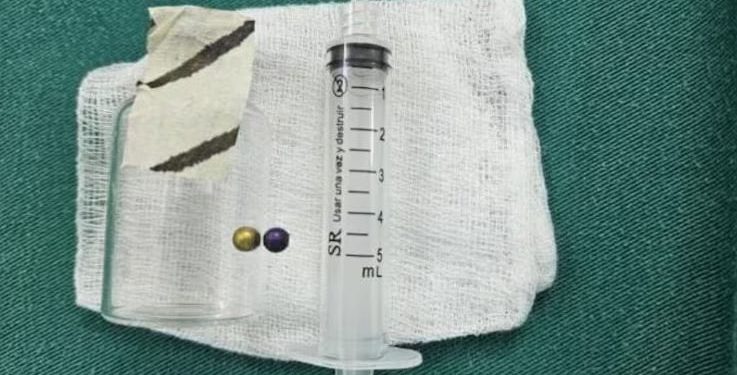 Niña de 4 años tragó un collar de perlas