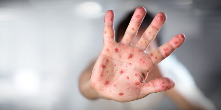 Sarampión bajo control: Salud da por cerrado brote tras tres meses sin contagios